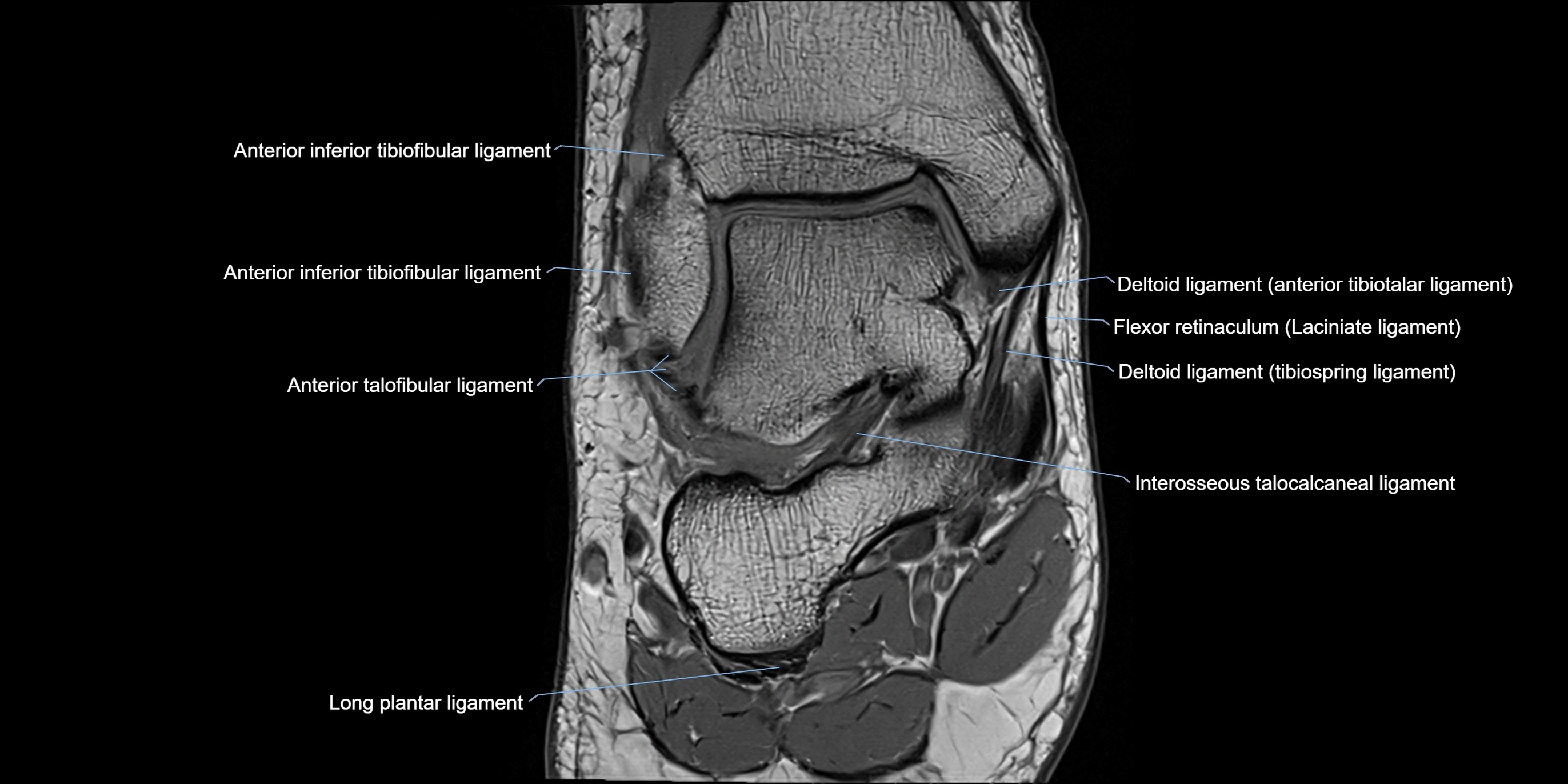MRI Ankle coronal ligaments cross sectional anatomy 3T  radiology  image-img-00001-00010.webp